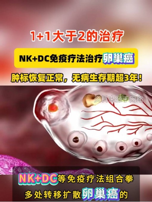 1+1大于2的治疗，NK+DC免疫疗法治疗卵巢癌，肿标恢复正常，无病生存期超3年!#NK细胞 #树突细胞 #免疫治疗 #卵巢癌