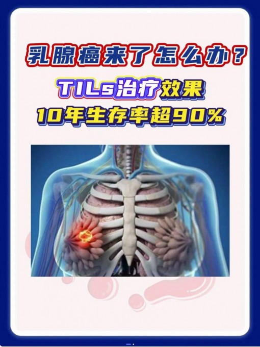 乳腺最新研究，TIls治疗效果，10年生存车超90% #乳腺癌 #TILs