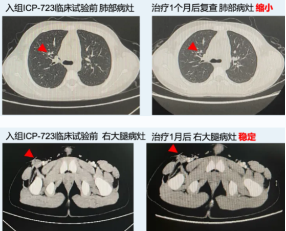 ICP723治疗梭形细胞恶性肿瘤的效果