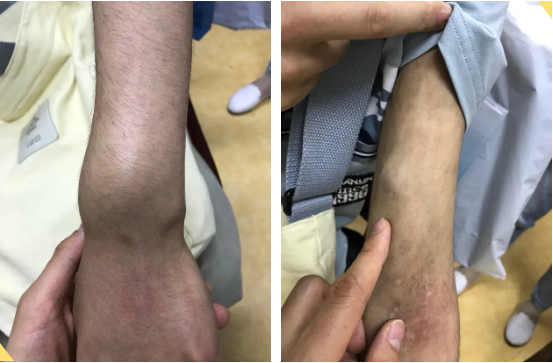CAR-T治疗急性B淋巴细胞白血病的效果