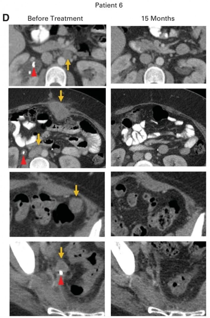 HPV-TIL细胞疗法治疗转移性腺癌的效果