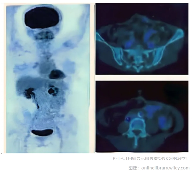 PET-CT扫描显示患者接受NK细胞治疗后