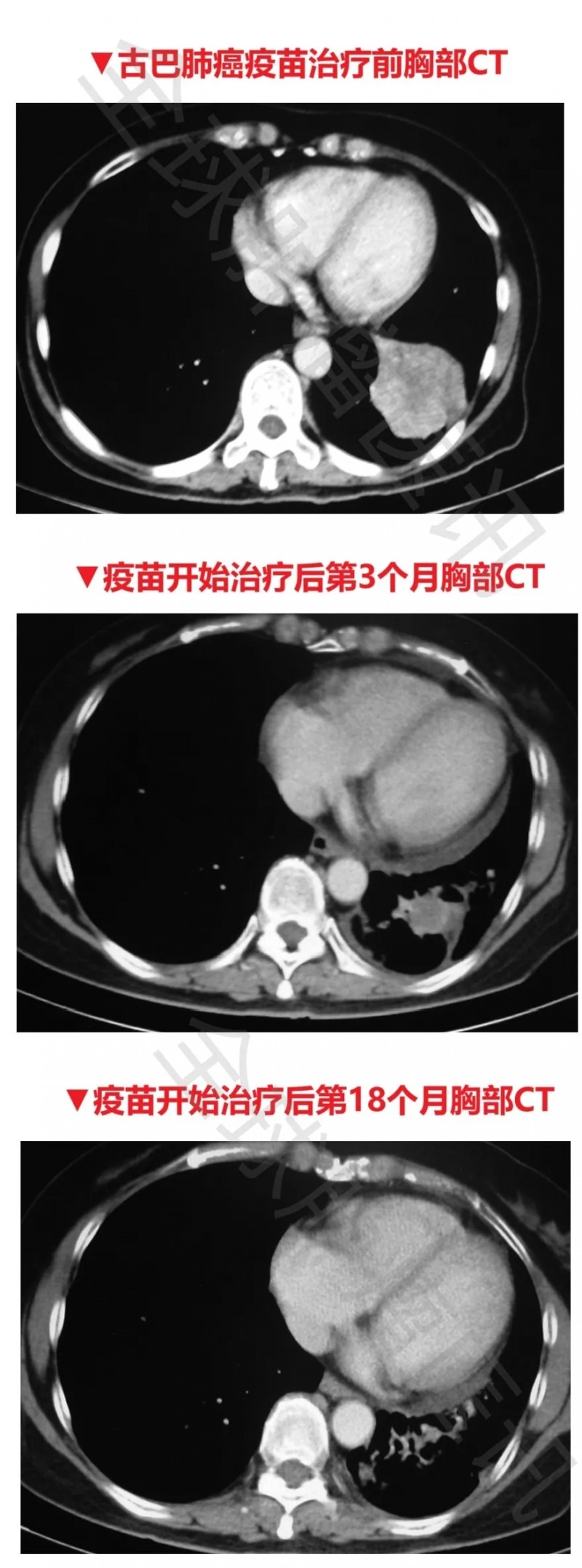 古巴肺癌疫苗治疗效果