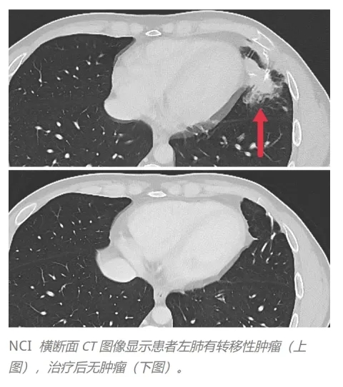 TCRT细胞疗法治疗转移性结直肠癌的效果
