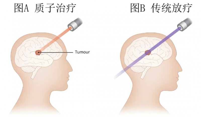 质子治疗脑瘤