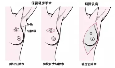保乳手术和全乳切除术示例图