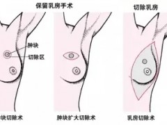 一次讲清楚乳腺癌手术保乳好还是全切好,除了手术还有哪些前沿疗法