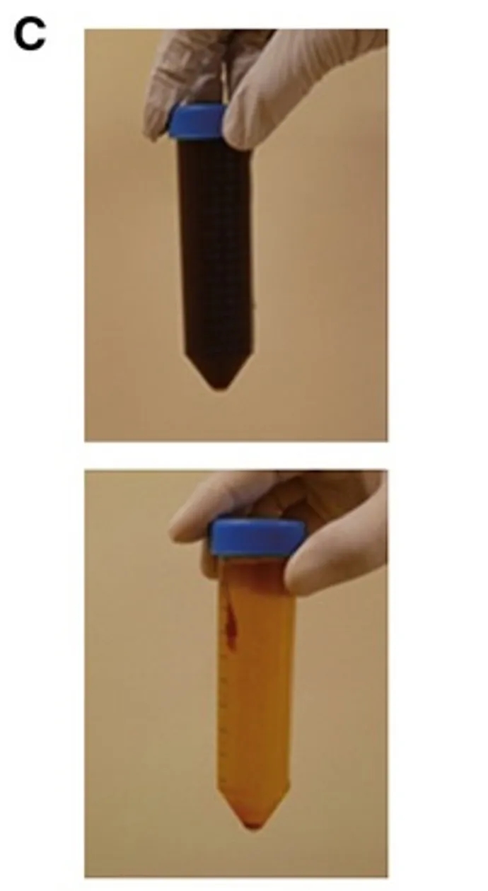 Vγ9Vδ2T细胞治疗胃癌腹水的效果