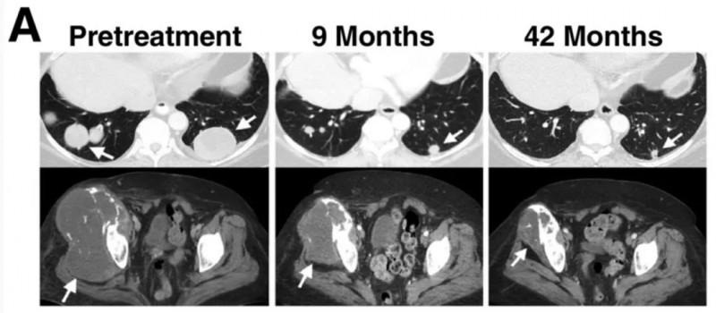 NY-ESO-1 TCR-T疗法治疗滑膜肉瘤肺转移灶的效果