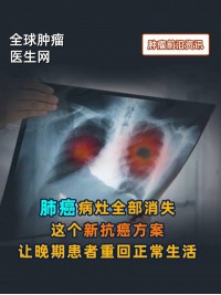 上海交通大学医学院案例：19个月无复发，免疫细胞+化疗暴击肠癌，转移灶隐身并完全缓解 #免疫治疗 #NK细胞 #肠癌