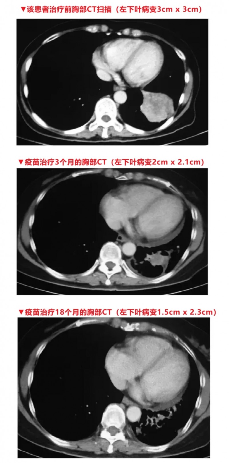 古巴肺癌疫苗治疗效果