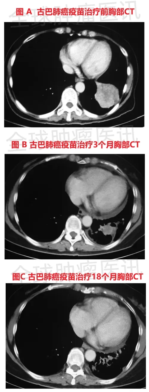 古巴肺癌疫苗治疗效果