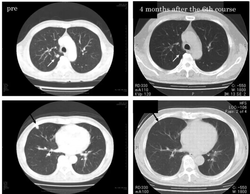 γ-δT细胞治疗肾癌肺转移的效果