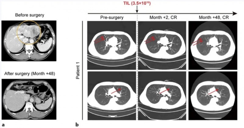 三联TIL细胞疗法治疗晚期肝癌的效果