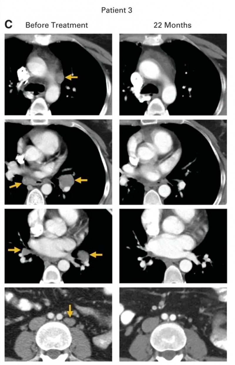 HPV-TILs疗法治疗转移性鳞状细胞宫颈癌的效果
