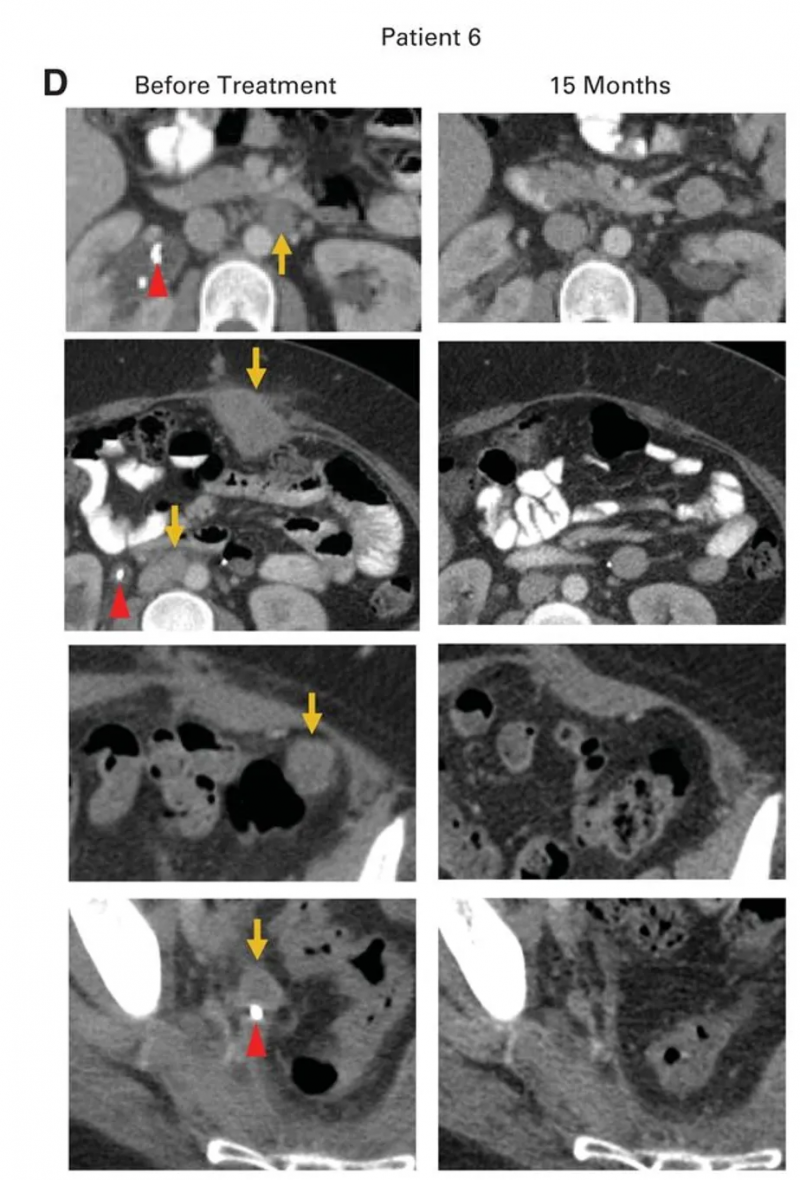 HPV-TILs疗法治疗转移性宫颈腺癌的效果