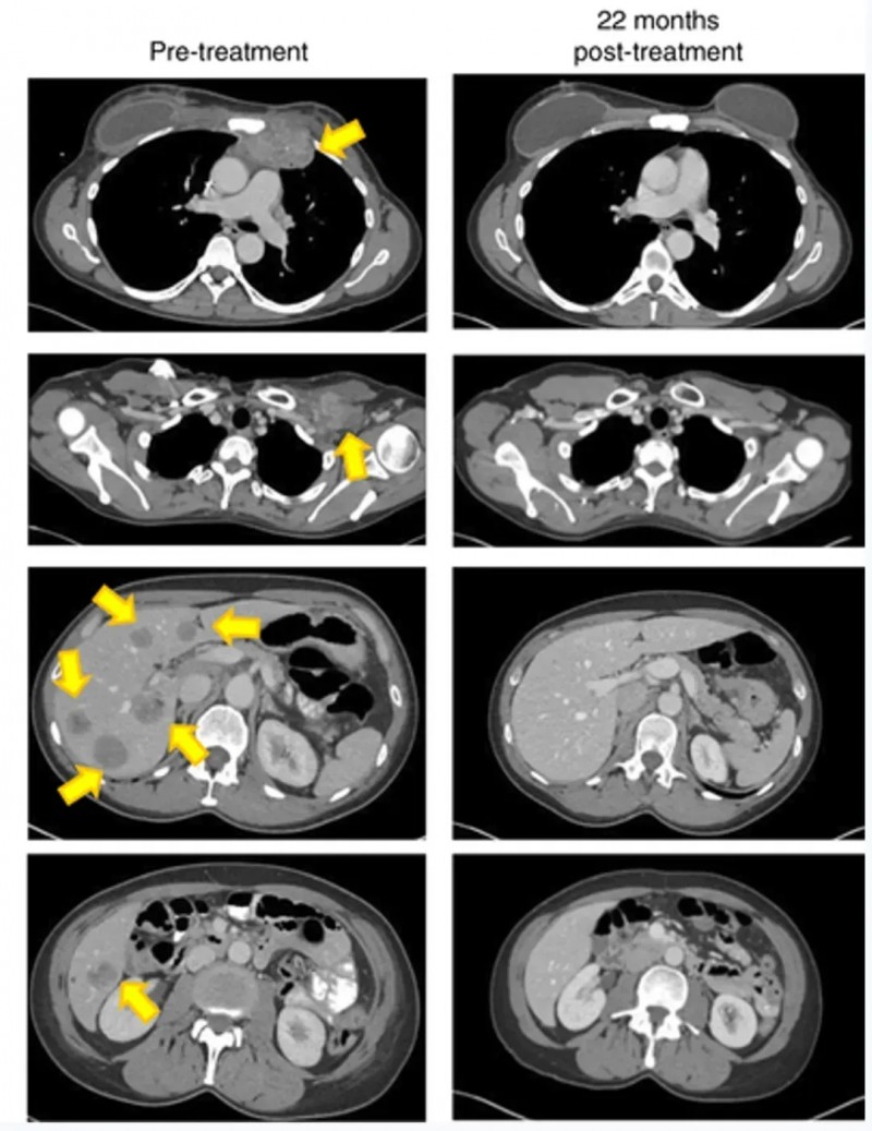 TIL细胞疗法治疗转移性乳腺癌的效果