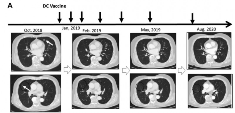 DC疫苗治疗肾癌肺转移的效果
