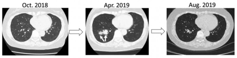 DC疫苗治疗女性尿路上皮癌的效果