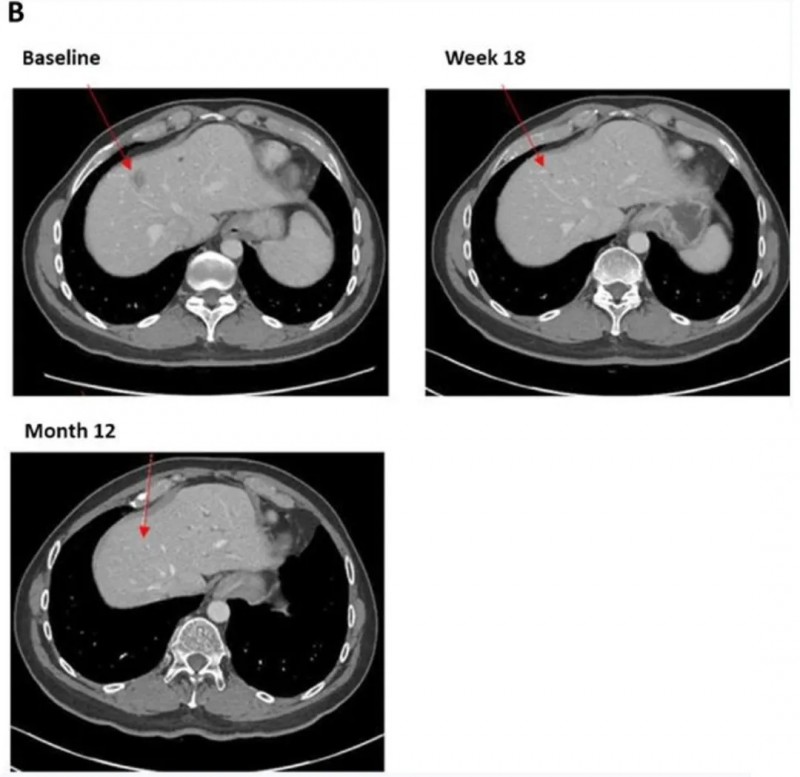 TIL细胞疗法治疗效果
