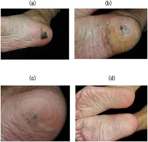 硼中子俘获疗法治疗黑色素瘤的效果