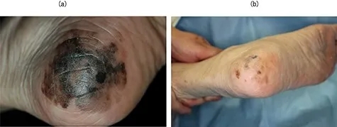 BNCT治疗足底黑色素瘤的效果