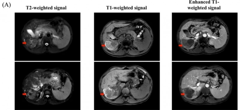 GPC3 CART治疗肝癌的效果