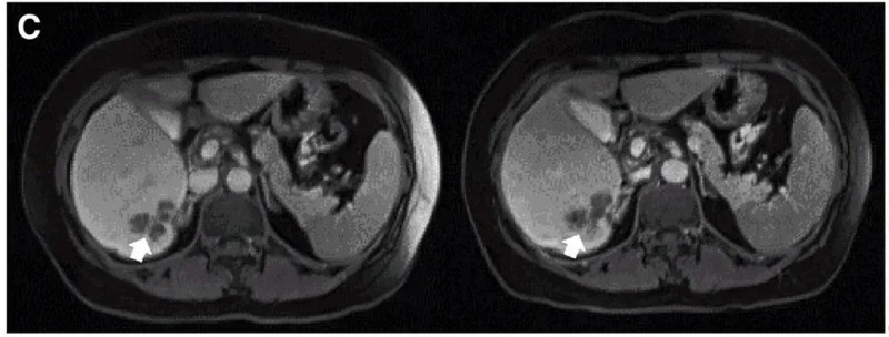 CEA CAR-T治疗结直肠癌的效果