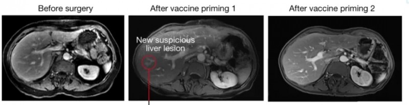 BNT122治疗胰腺癌的效果