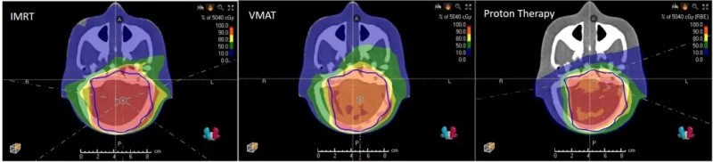 质子治疗儿童脑瘤的辐射范围