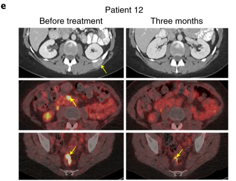 E7 TCR-T疗法治疗HPV阳性的转移性宫颈鳞状细胞癌的效果