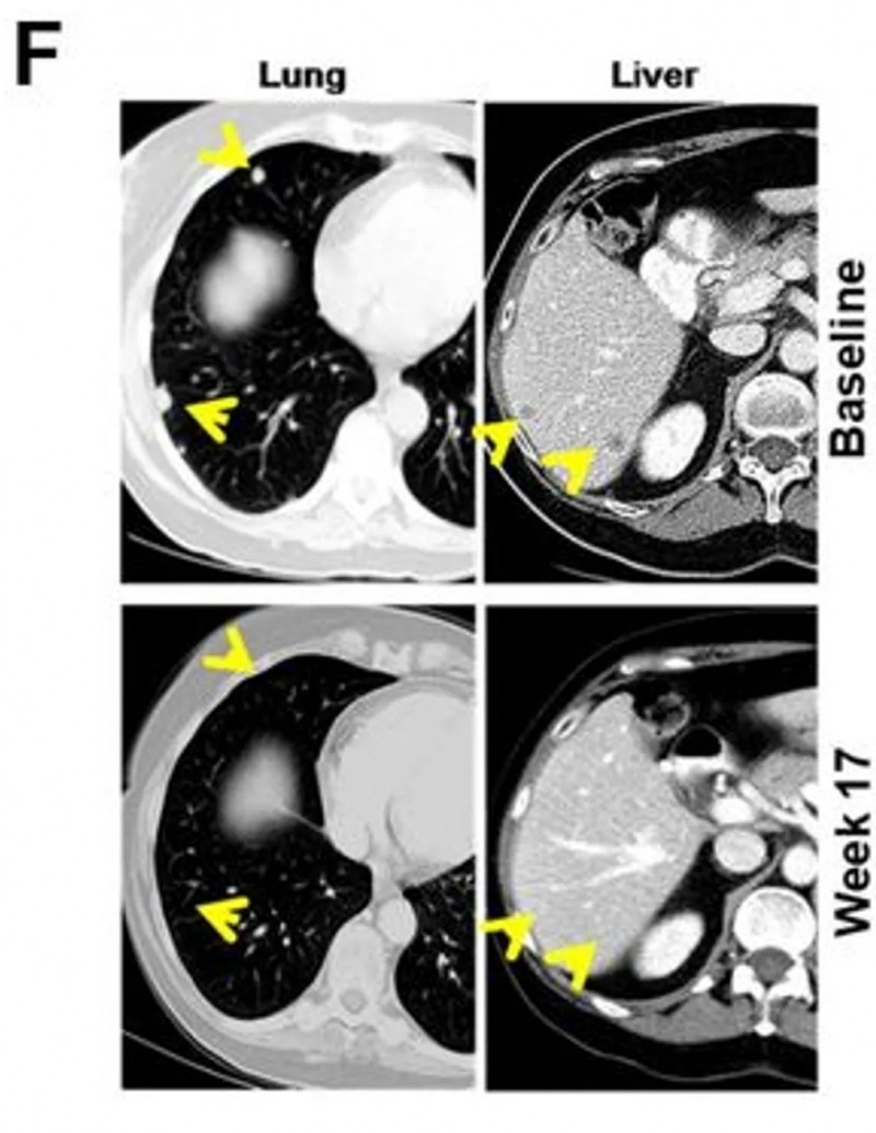 PD-1抑制剂的治疗效果