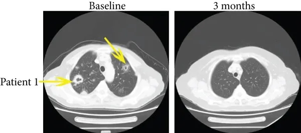 TIL细胞疗法联合PD-1治疗化疗耐药宫颈癌伴肺转移的效果