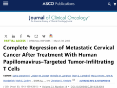 HPV-TIL细胞疗法治疗化疗难治的宫颈癌最长完全缓解22个月无复发