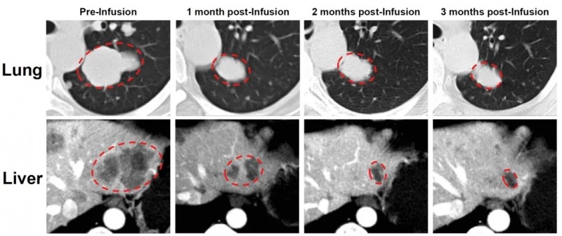 TIL疗法GC203治疗卵巢子宫内膜样癌的效果