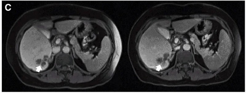 CEA CAR-T治疗结直肠癌的效果