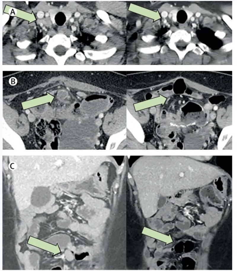 CRISPR-TIL细胞疗法治疗结直肠癌的效果