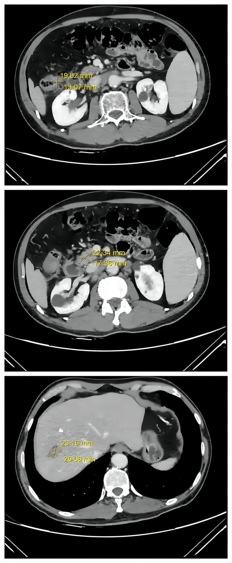 粪菌移植联合替雷利珠单抗+贝伐珠单抗治疗晚期结直肠癌的效果