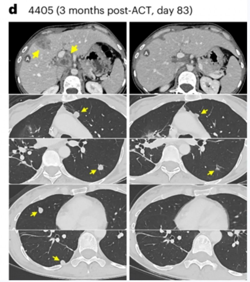 TCR-T细胞疗法治疗转移性直肠癌的效果