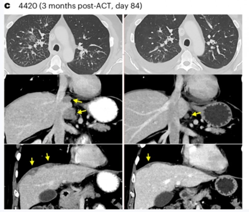 TCR-T细胞疗法治疗转移性结肠癌的效果