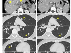 TCR-T细胞疗法治疗多线失败的结直肠癌，42.8%的患者客观缓解，多人转移灶消退