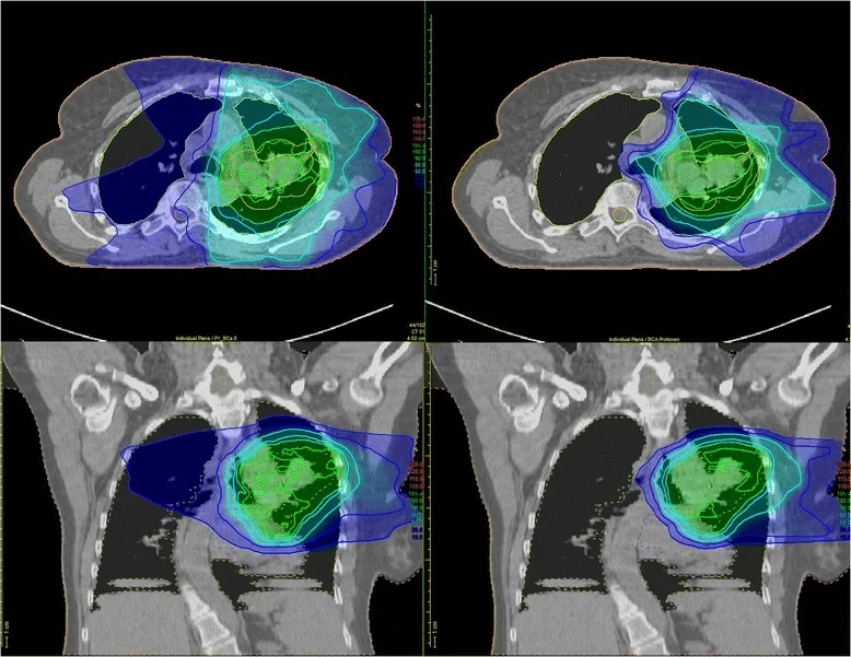 质子刀治疗肺癌的辐射优势