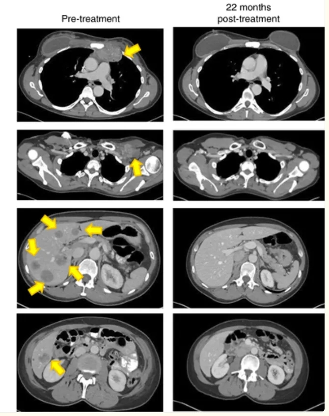TIL细胞疗法治疗乳腺癌的效果