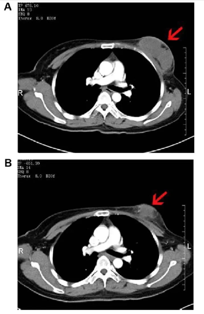 NK细胞疗法治疗乳腺癌的效果