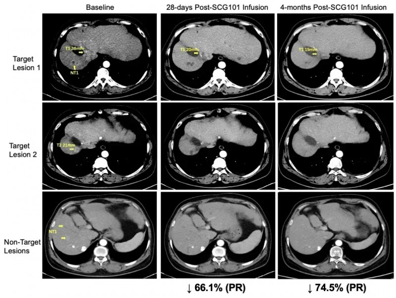 SCG101治疗肝癌的效果