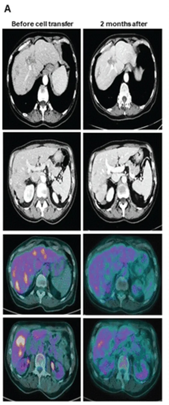 NK细胞疗法治疗胃肠道肿瘤的效果
