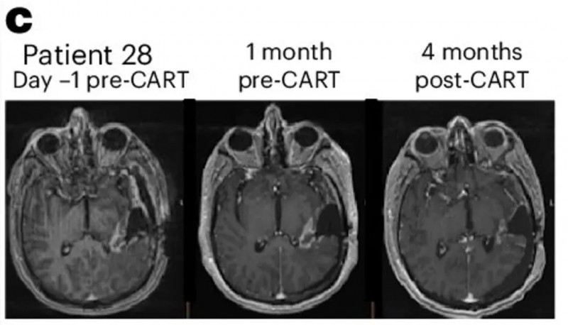 双靶点CAR-T治疗胶质母细胞瘤的效果