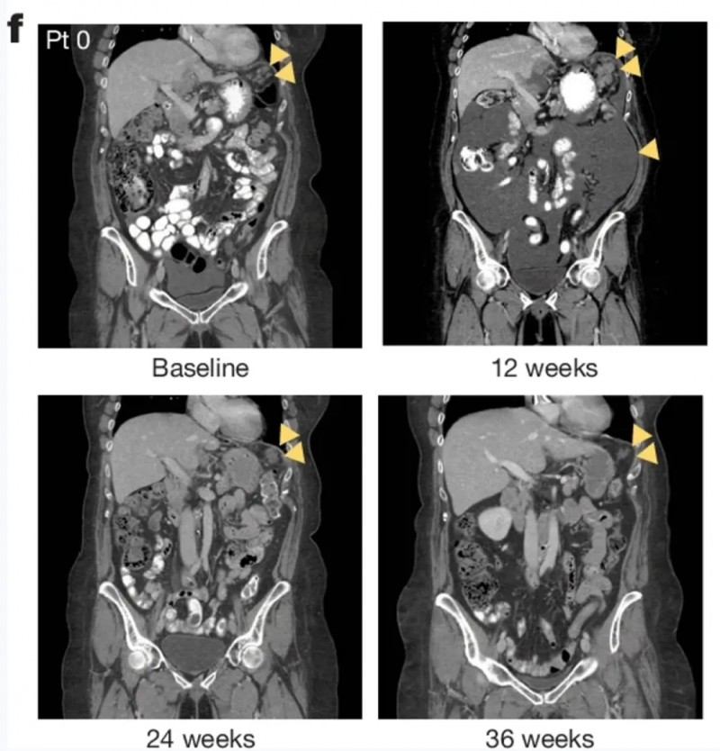 CAR-NK细胞疗法治疗效果