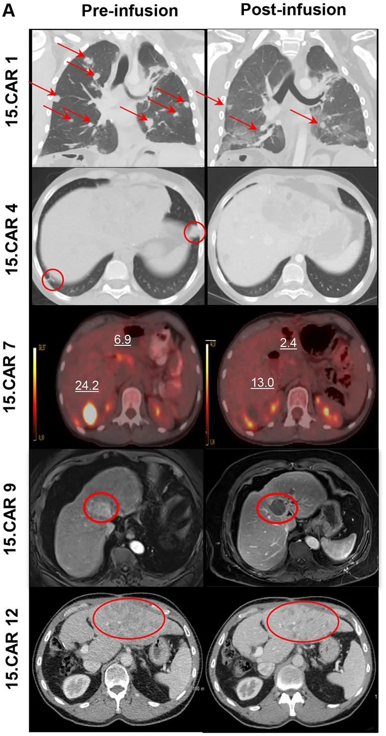 GPC3 CART细胞疗法治疗肝癌的效果