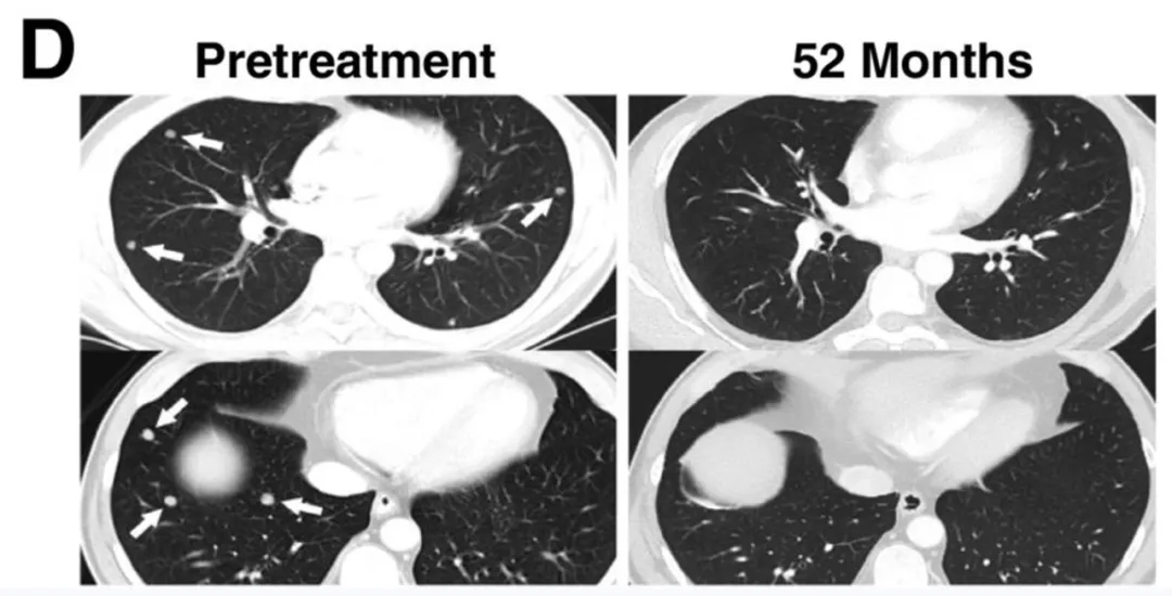 NY-ESO-1治疗黑色素瘤的效果